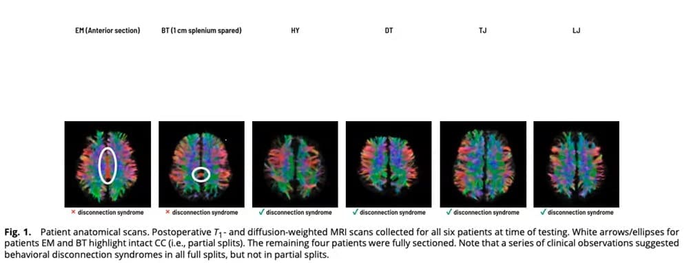 Split Brain Scan New Findings in Split-Brain Science: Even Minimal Fiber Connections Can ...
